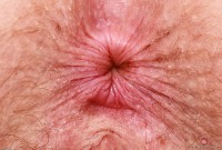 ATK hairy Apricot Pitts Set