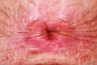 ATK hairy Apricot Pitts in young and hairy