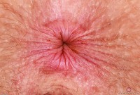 ATK hairy Apricot Pitts in young and hairy