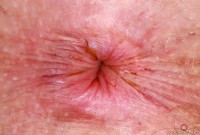 ATK hairy Apricot Pitts Set