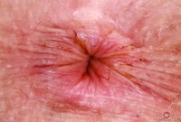 ATK hairy Apricot Pitts Set