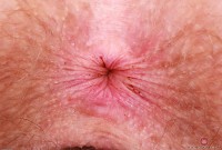 ATK hairy Apricot Pitts Set