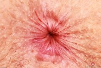 ATK hairy Apricot Pitts Set