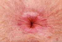 ATK hairy Apricot Pitts Set