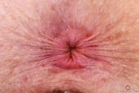 ATK hairy Apricot Pitts Set