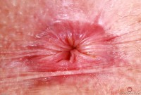 ATK hairy Apricot Pitts Set