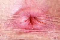 ATK hairy Apricot Pitts Set