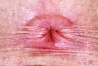 ATK hairy Apricot Pitts Set