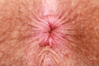 ATK hairy Apricot Pitts Set