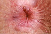 ATK hairy Apricot Pitts Set