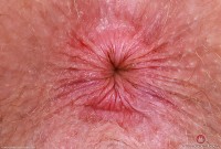 ATK hairy Apricot Pitts Set