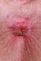 ATK hairy Apricot Pitts Set