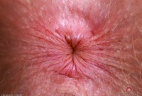 ATK hairy Apricot Pitts Set