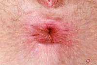 ATK hairy Apricot Pitts in young and hairy