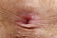 ATK hairy  in young and hairy