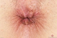 ATK hairy  in mature and hairy