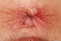 ATK hairy  in mature and hairy