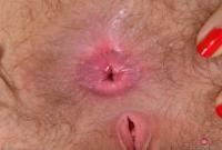 ATK hairy  in young and hairy