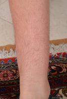ATK hairy  in young and hairy