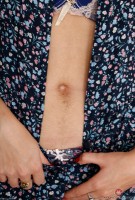 ATK hairy  in young and hairy