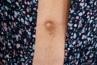 ATK hairy  in young and hairy