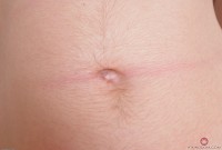 ATK hairy  in young and hairy