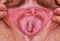 ATK hairy  in young and hairy