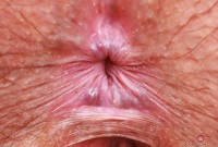 ATK hairy  in young and hairy