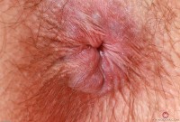 ATK hairy  in young and hairy