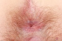 ATK hairy  in young and hairy