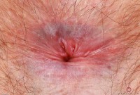 ATK hairy  in young and hairy