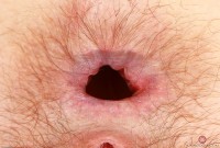 ATK hairy  in young and hairy