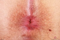ATK hairy  in exotic and hairy