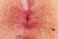 ATK hairy  in exotic and hairy