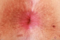ATK hairy  in exotic and hairy