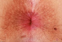 ATK hairy  in exotic and hairy