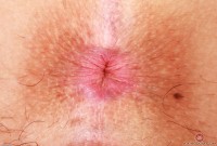 ATK hairy  in exotic and hairy