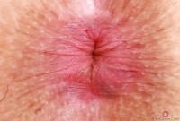 ATK hairy  in exotic and hairy