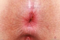 ATK hairy  in young and hairy