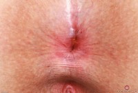 ATK hairy Bess Breast Set