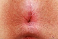 ATK hairy  in young and hairy