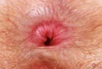 ATK hairy  in young and hairy