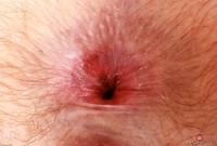 ATK hairy  in young and hairy