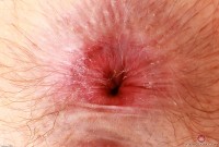ATK hairy  in young and hairy