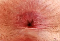 ATK hairy  in young and hairy