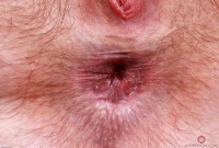 ATK hairy  in young and hairy
