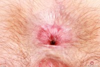 ATK hairy  in young and hairy