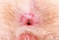 ATK hairy  in young and hairy