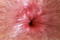 ATK hairy  in young and hairy