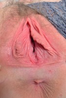 ATK hairy  in young and hairy